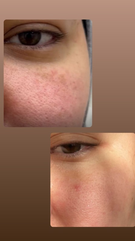 RF лифтинг на annapame Vivace