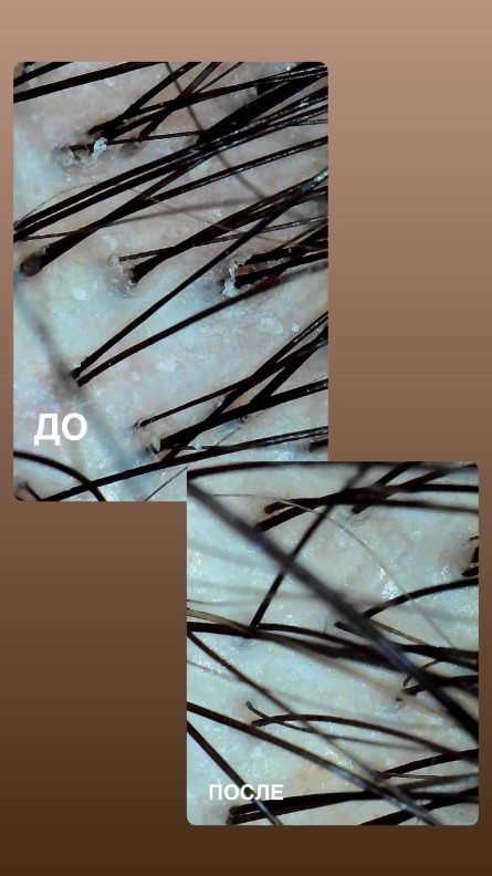 Спа-пилинг кожи головы и волос