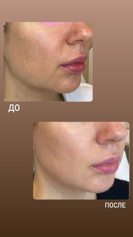 RF лифтинг на annapame Vivace